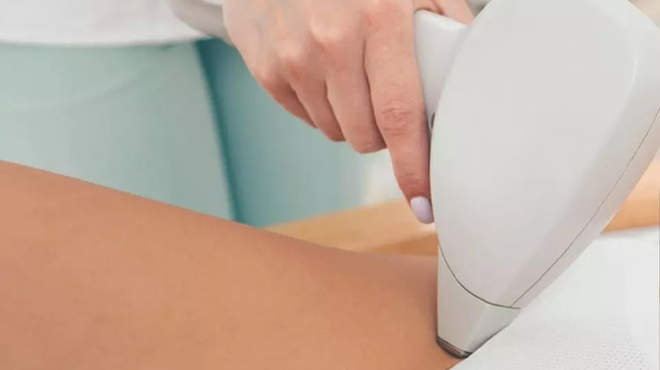 Laser Hair Removal Treatment